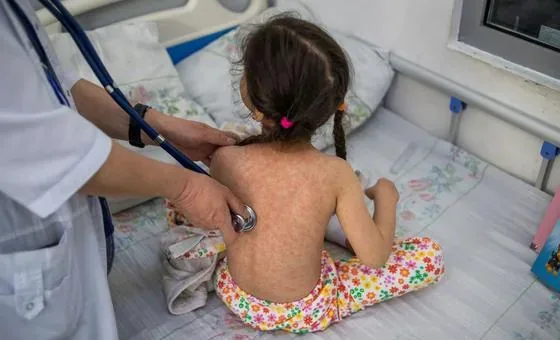 Opas vê risco “muito alto” de propagação do sarampo na América do Sul